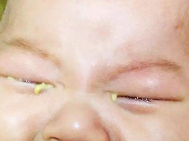 第三代试管代孕宝宝眼屎多是什么原因